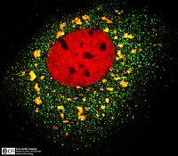 ZBPs (zipcode binding proteins) help protect mRNAs from degradation in tumours and, together with these, localise into stress corpuscles (Foto: MLU)